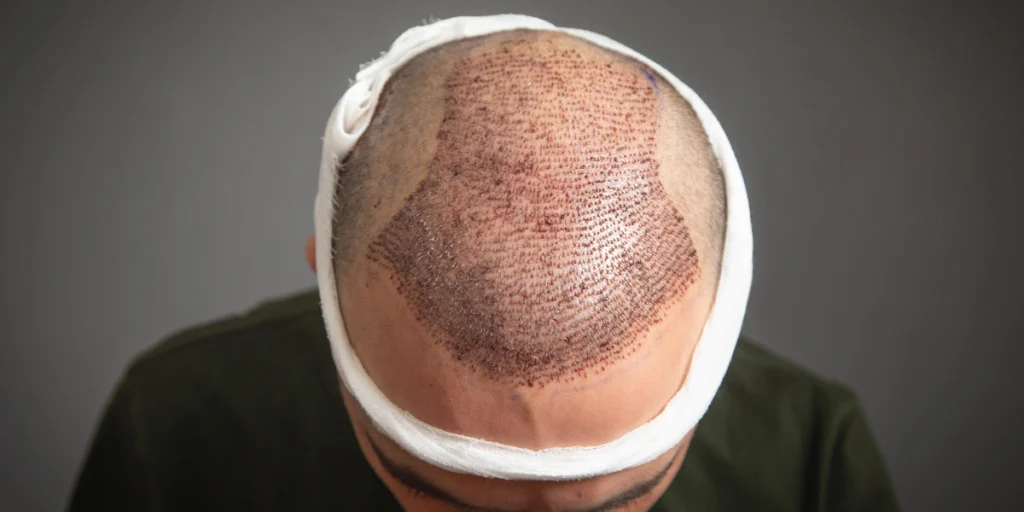Hair Transplant for Men in Birmingham showing post-surgery graft placement and scalp healing process.