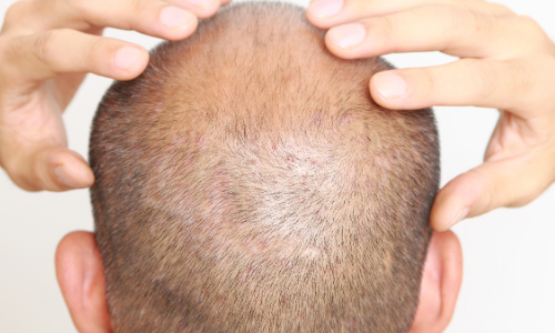 FUE Aftercare (1) FUE Aftercare (1)
