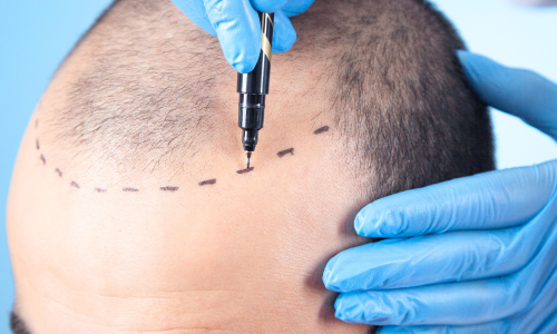 Our-Approach-Phoenix-Hair-Transplants-1 Our-Approach-Phoenix-Hair-Transplants-1
