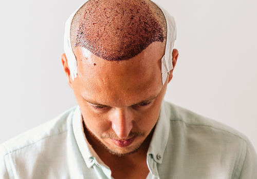Phoenix-Hair-Transplants-3 Phoenix-Hair-Transplants-3